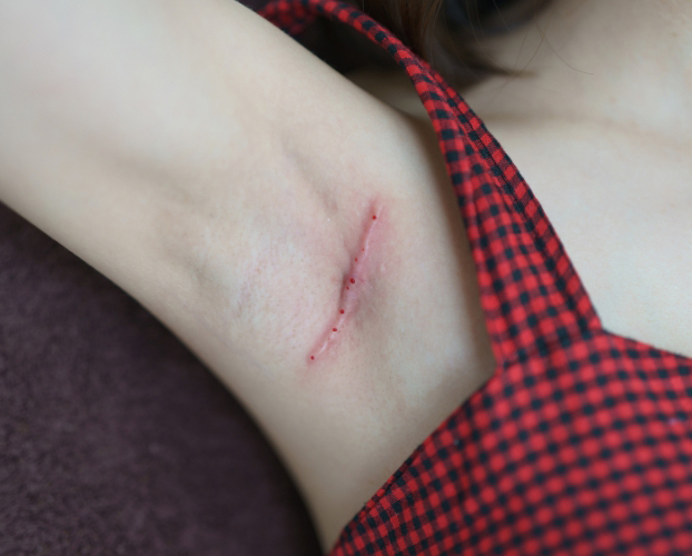 Trị Sẹo Lồi Tại Sen Beauty